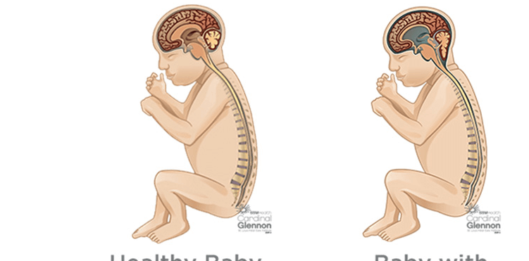 Baby:6ljdk4wj_Gu= Hydrocephalus