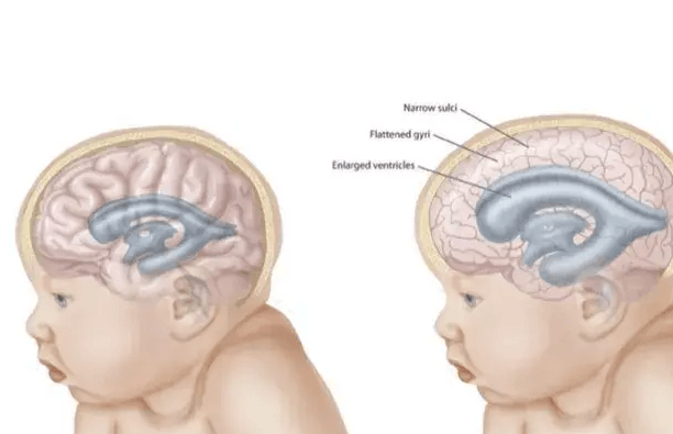 Baby:6ljdk4wj_Gu= Hydrocephalus